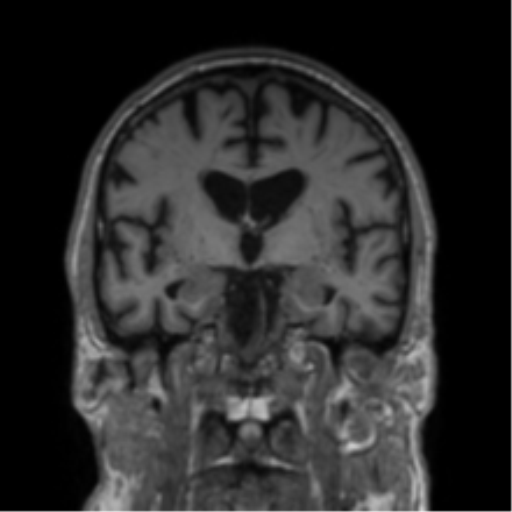 File:Alzheimer's disease- with Gerstmann syndrome and dressing apraxia (Radiopaedia 54882-61150 Coronal T1 49).png