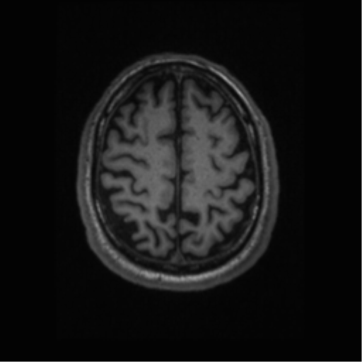 Alzheimer disease - probable (Radiopaedia 35334-36837 Axial T1 58).png