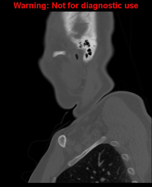 Ameloblastoma (Radiopaedia 33126-34164 Sagittal bone window 62).jpg