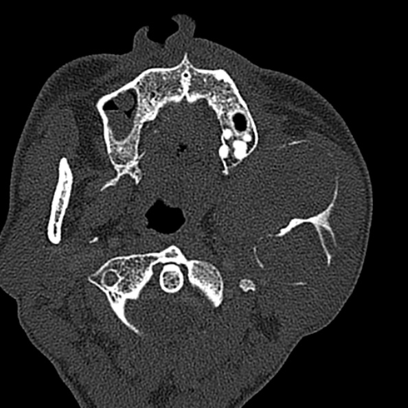Ameloblastoma (Radiopaedia 51921-57766 Axial bone window 105).jpg