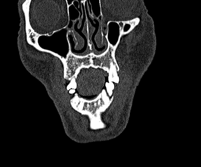 Ameloblastoma (Radiopaedia 51921-57766 Coronal bone window 36).jpg