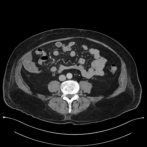 Ampullary adenocarcinoma (Radiopaedia 59373-66737 A 102).jpg