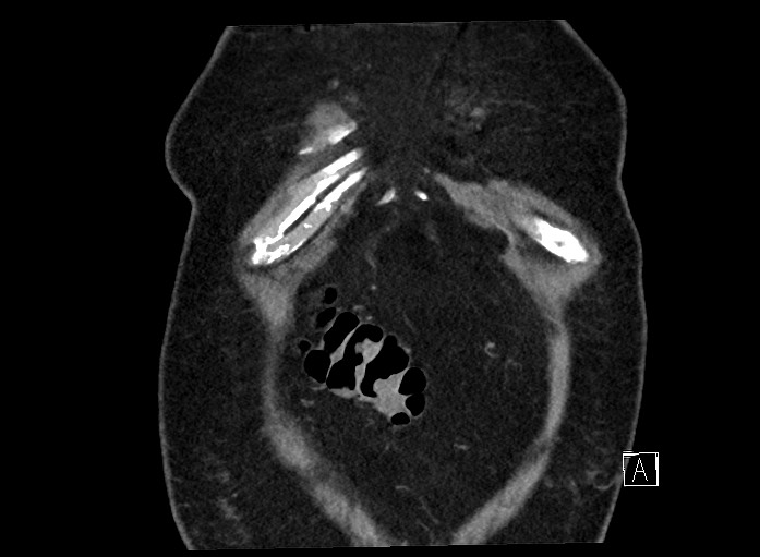 Ampullary adenocarcinoma (Radiopaedia 59373-66737 B 9).jpg