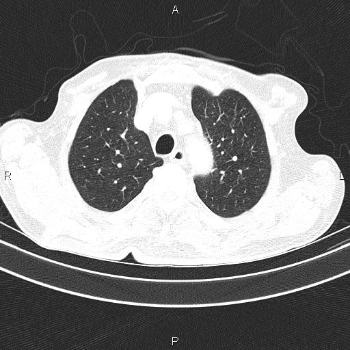 Ampullary adenocarcinoma (Radiopaedia 86093-102033 Axial lung window 21).jpg