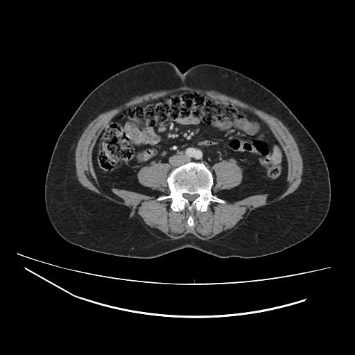 Ampullary tumor (Radiopaedia 60333-67998 A 51).jpg