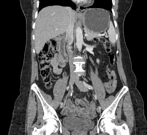Ampullary tumor (Radiopaedia 60333-67998 B 41).jpg