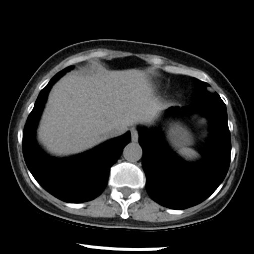 File:Amyloidosis - bronchial and diffuse nodular pulmonary involvement (Radiopaedia 60156-67744 Axial non-contrast 48).jpg