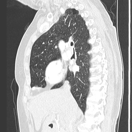 File:Amyloidosis - bronchial and diffuse nodular pulmonary involvement (Radiopaedia 60156-67745 Sagittal lung window 37).jpg