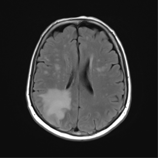 File:Anaplastic astrocytoma (Radiopaedia 86943-103160 Axial FLAIR 18).png