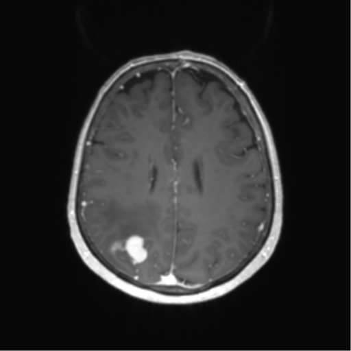 File:Anaplastic astrocytoma (Radiopaedia 86943-103160 Axial T1 C+ 49).png