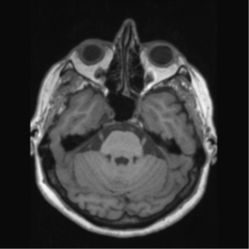 Anaplastic astrocytoma IDH wild-type (pseudoprogression) (Radiopaedia 42209-45276 Axial T1 51).png