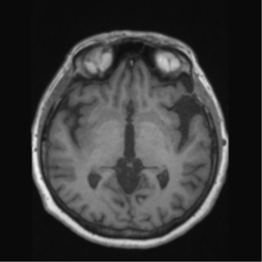 Anaplastic astrocytoma IDH wild-type (pseudoprogression) (Radiopaedia 42209-45276 Axial T1 75).png