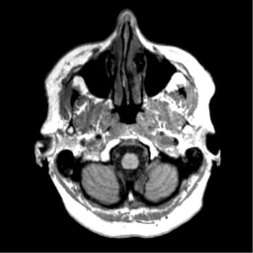 File:Anaplastic astrocytoma IDH wild-type (pseudoprogression) (Radiopaedia 42209-45277 Axial T1 12).png