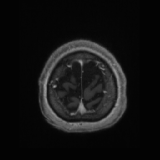 Anaplastic astrocytoma IDH wild-type (pseudoprogression) (Radiopaedia 42209-45277 Axial T1 C+ 119).png