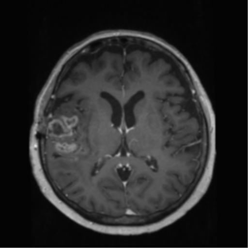 File:Anaplastic astrocytoma IDH wild-type (pseudoprogression) (Radiopaedia 42209-45278 Axial T1 C+ 87).png