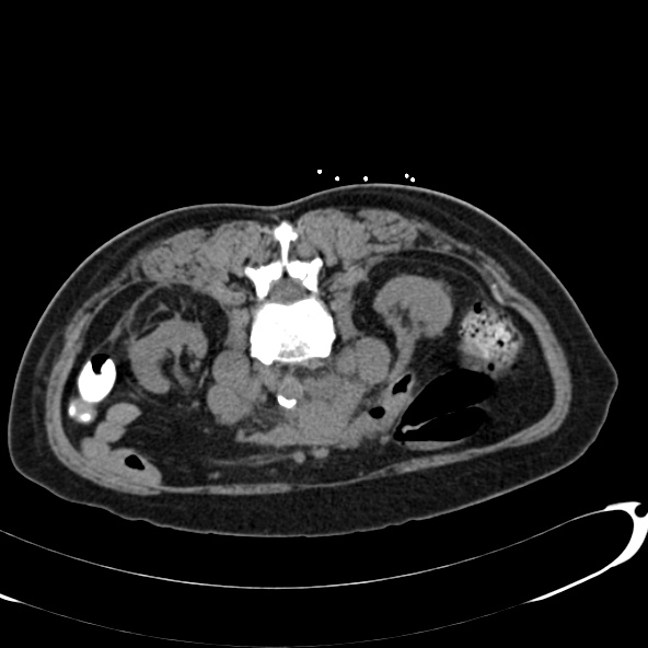 File:Anaplastic lymphoma - with CT biopsy (Radiopaedia 21643-21602 Axial non-contrast 31).jpg