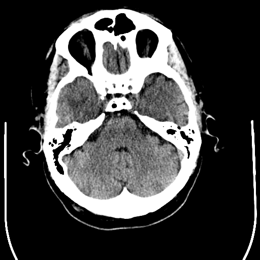 File:Anaplastic meningioma with recurrence (Radiopaedia 34452-35781 Axial non-contrast 9).png