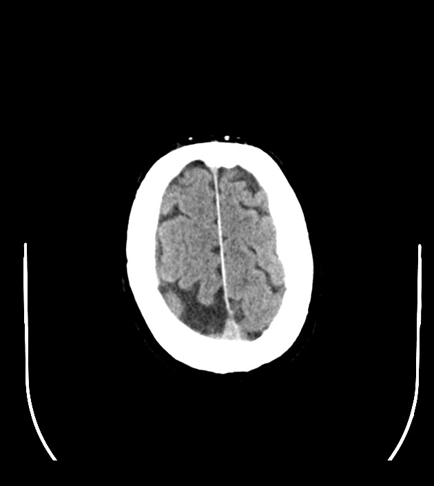 Anaplastic oligodendroglioma (Radiopaedia 79571-92755 Axial non-contrast 47).jpg