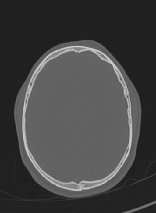 Anaplastic oligodendroglioma with skull fracture (Radiopaedia 74831-85846 Axial bone window 12).png