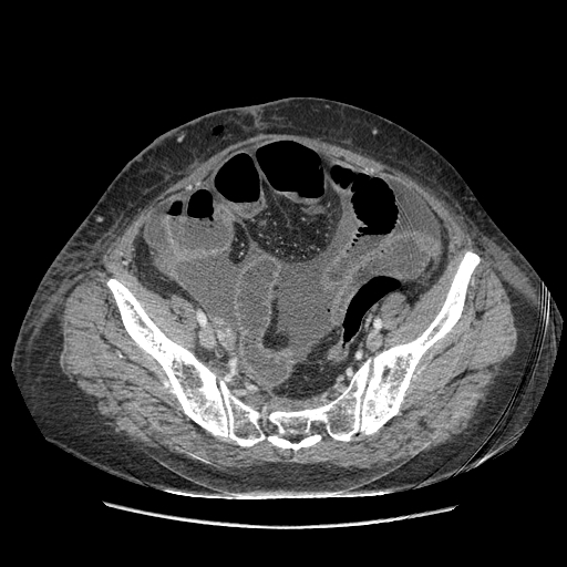 Anastomosis leak at ileostomy closure site (Radiopaedia 82138-96184 B 191).jpg