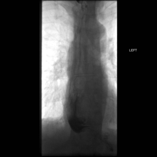 File:Anastomotic stricture post Ivor Lewis esophagectomy (Radiopaedia 47937-52715 B 50).png