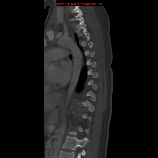 File:Aneurysmal bone cyst (Radiopaedia 9419-10102 Sagittal bone window 14).jpg