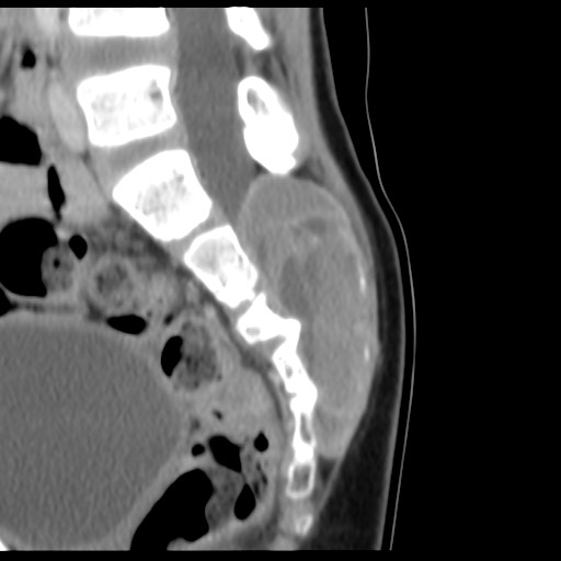 File:Aneurysmal bone cyst - sacrum (Radiopaedia 65190-74195 A 14).jpg