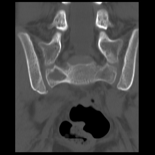 File:Aneurysmal bone cyst - sacrum (Radiopaedia 65190-74195 Coronal bone window 5).jpg