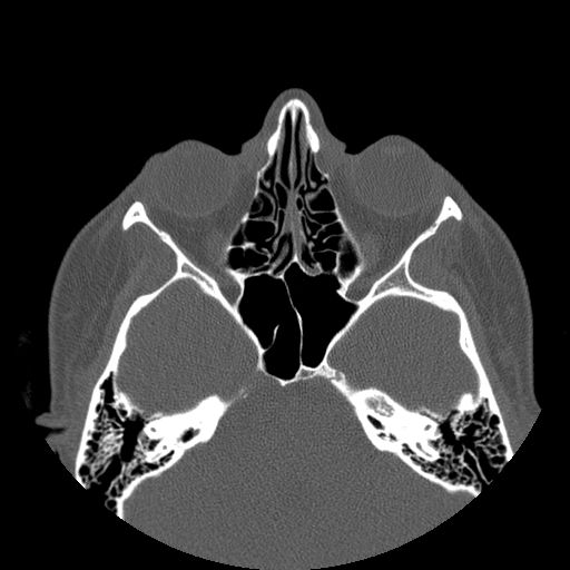 Aneurysmal bone cyst of the mandible (Radiopaedia 43280-46823 Axial bone window 162).jpg