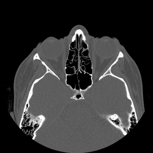 Aneurysmal bone cyst of the mandible (Radiopaedia 43280-46823 Axial bone window 169).jpg
