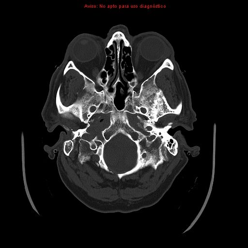 File:Aneurysmal subarachnoid hemorrhage (Radiopaedia 24740-24997 bone window 5).jpg