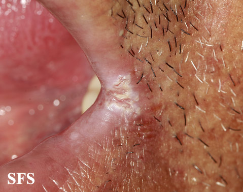 Angular Cheilitis (Dermatology Atlas 6).jpg