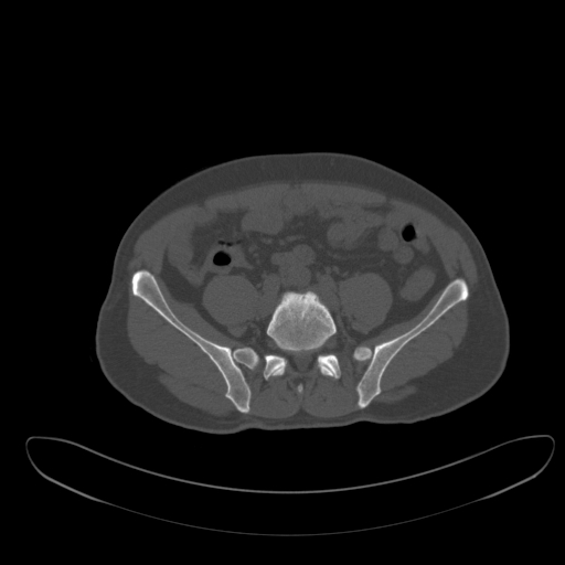 File:Ankylosing spondylitis (Radiopaedia 52728-58645 Axial bone window 1).jpg