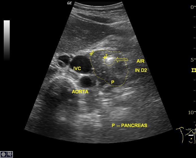File:Annular pancreas (Radiopaedia 35777-37333 I 1).jpg