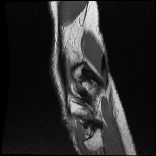 Anomalous insertion of the medial meniscus (Radiopaedia 77559-89721 Sagittal PD 9).jpg