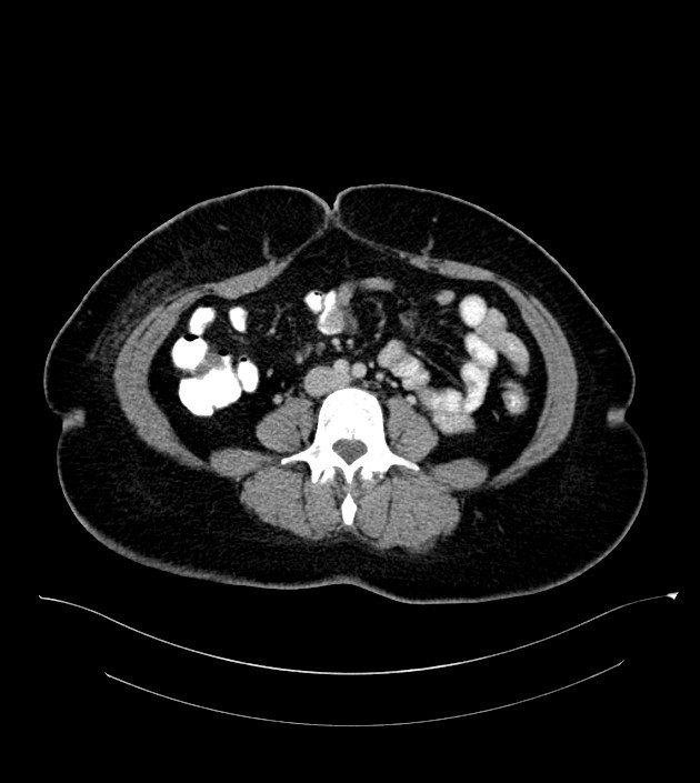Anterior abdominal wall CSF pseudocyst (CSFoma) (Radiopaedia 79453-92571 A 55).jpg