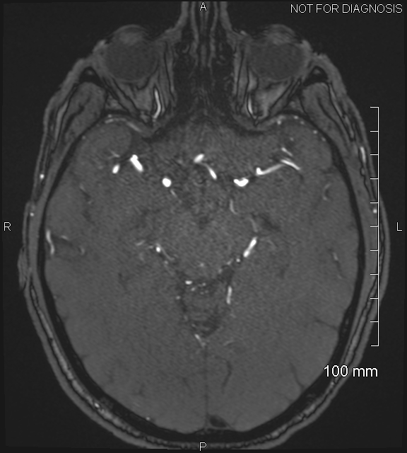 Anterior cerebral artery aneurysm (Radiopaedia 80683-94127 Axial MRA 101).jpg