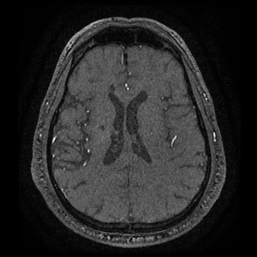 Anterior cerebral artery infarction (Radiopaedia 46794-51323 Axial MRA 134).jpg