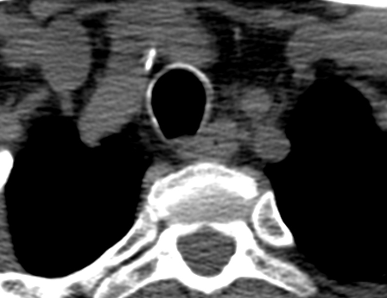 Anterior cervical postdiscectomy arthrodesis (Radiopaedia 32678-33646 Axial non-contrast 74).jpg