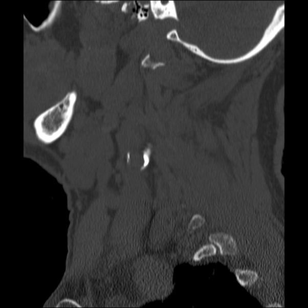 Anterior cervical postdiscectomy arthrodesis (Radiopaedia 32678-33646 Sagittal bone window 7).jpg