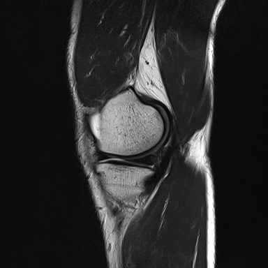 File:Anterior cruciate ligament full thickness tear (Radiopaedia 66268-75467 Sagittal T2 6).jpg