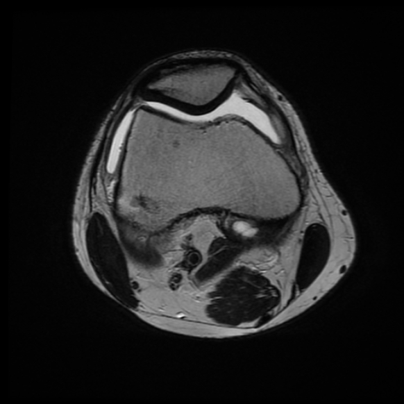 File:Anterior cruciate ligament graft tear and bucket-handle tear of medial meniscus (Radiopaedia 75867-87255 Axial T2 18).jpg