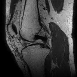 Anterior cruciate ligament rupture with Segond fracture (Radiopaedia 69043-78806 Sagittal PD 84).jpg