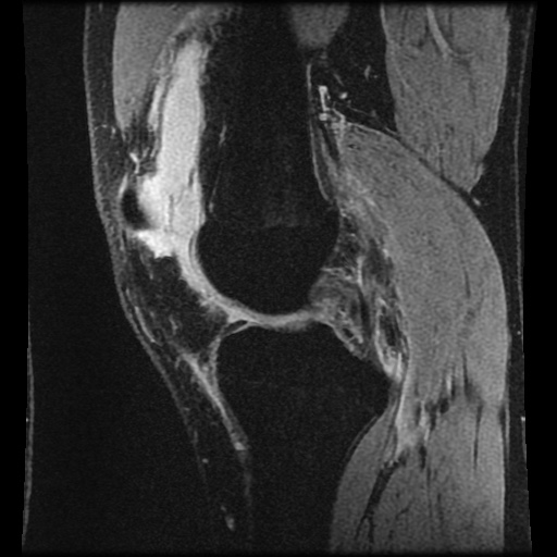 File:Anterior cruciate ligament tear (Radiopaedia 61500-69462 F 32).jpg