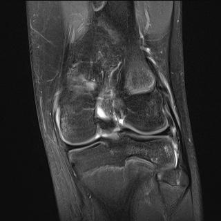 File:Anterior cruciate ligament tear - pediatric (Radiopaedia 62152-70260 Coronal PD fat sat 9).jpg