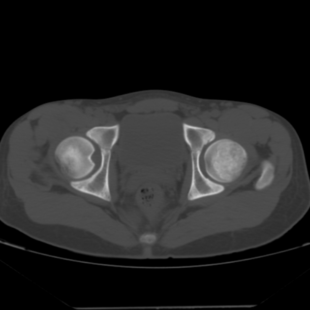 Anterior inferior iliac spine avulsion fracture (Radiopaedia 49469-54627 Axial bone window 41).jpg