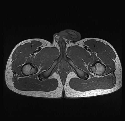 File:Anterior inferior iliac spine avulsion fracture (Radiopaedia 81312-95000 Axial T1 2).jpg