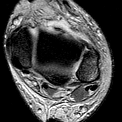 File:Anterior talofibular ligament rupture (Radiopaedia 15831-15484 Axial T2* 7).jpg