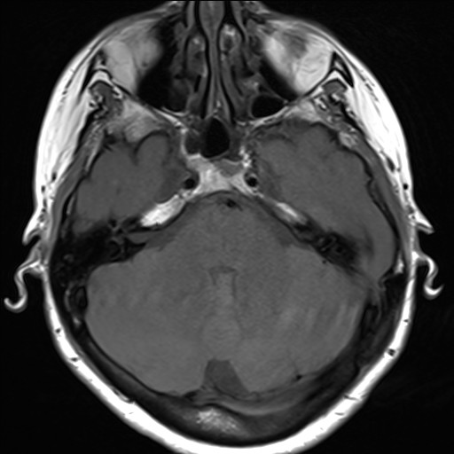 File:Anterior temporal encephalocele (Radiopaedia 82624-96808 Axial T1 9).jpg