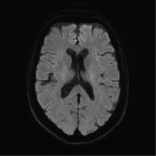 Anterior temporal pole cysts (Radiopaedia 46629-51102 Axial DWI 43).png
